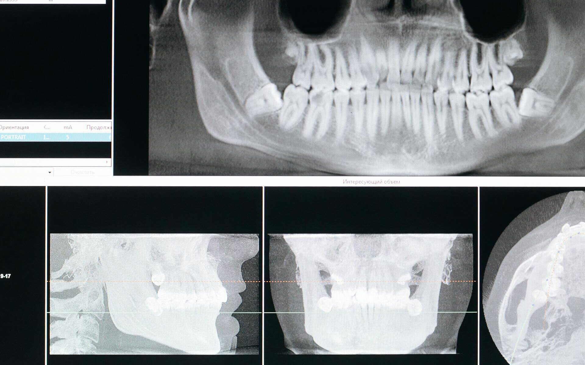 Why Does Periodontal Disease Become More Common as We Get Older?