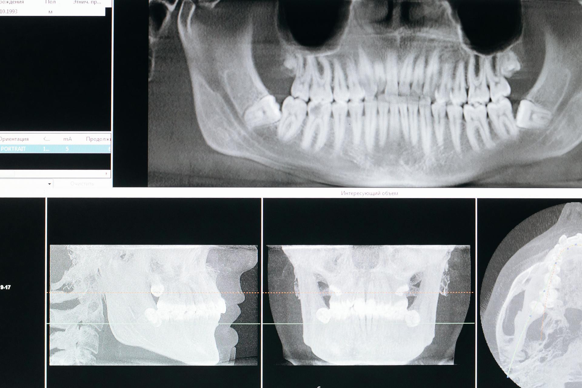 Why Does Periodontal Disease Become More Common as We Get Older?