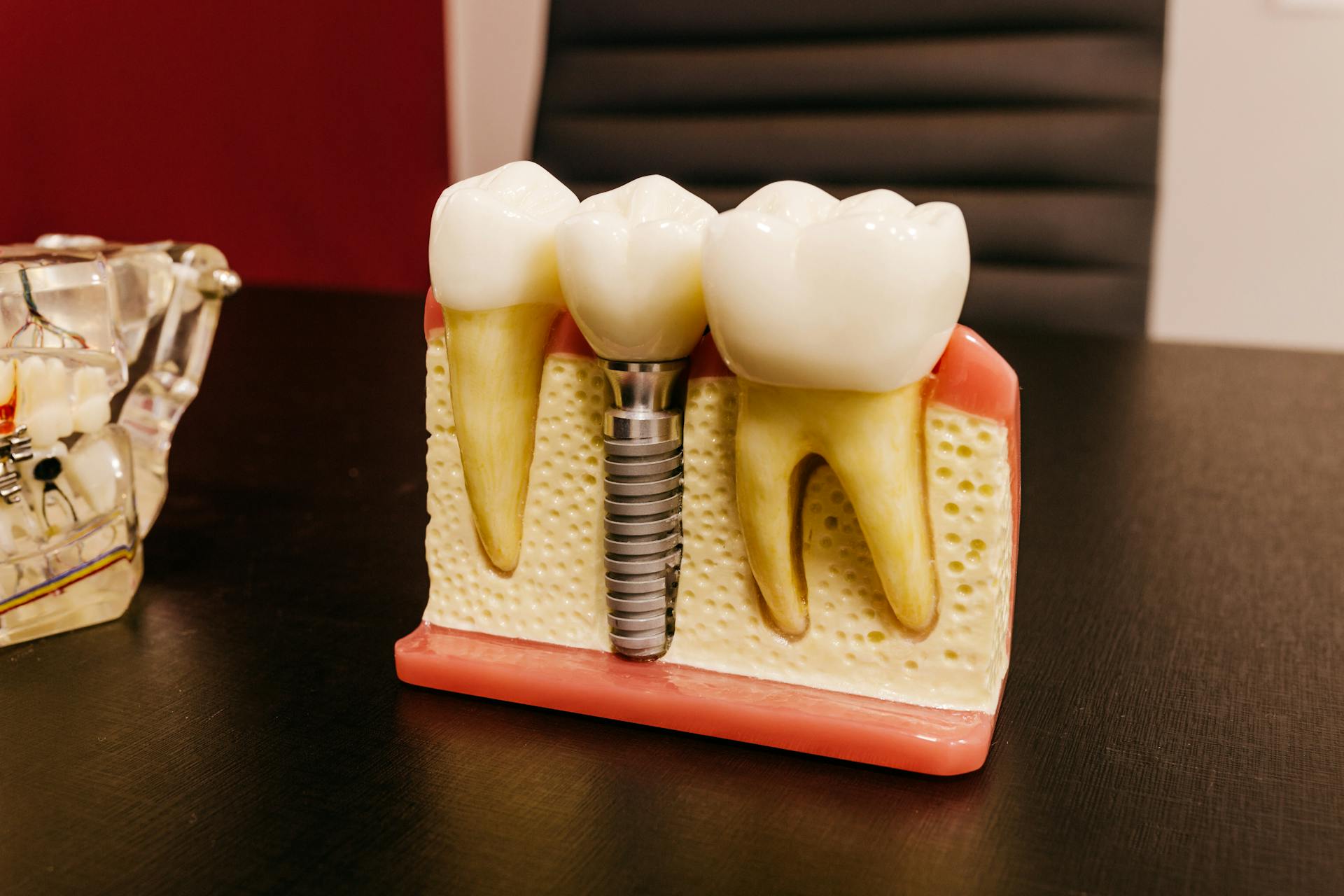 Why Is There an Issue With Getting Dental Implants Through California’s Medi-Cal?