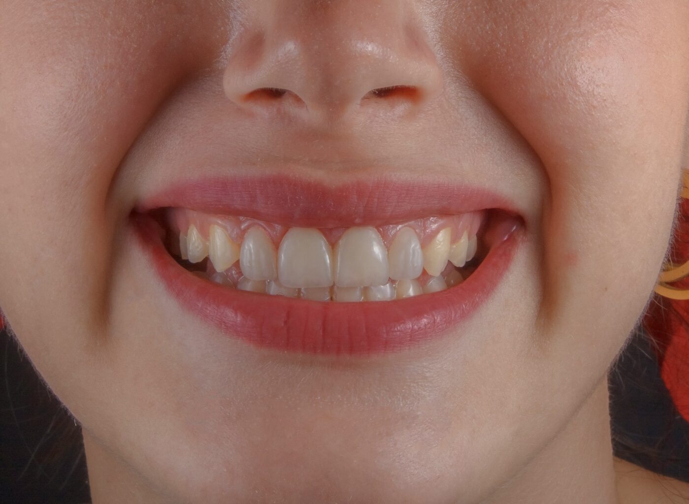 Why Is It Important To Ignore TikTok When It Comes to Filing Teeth?