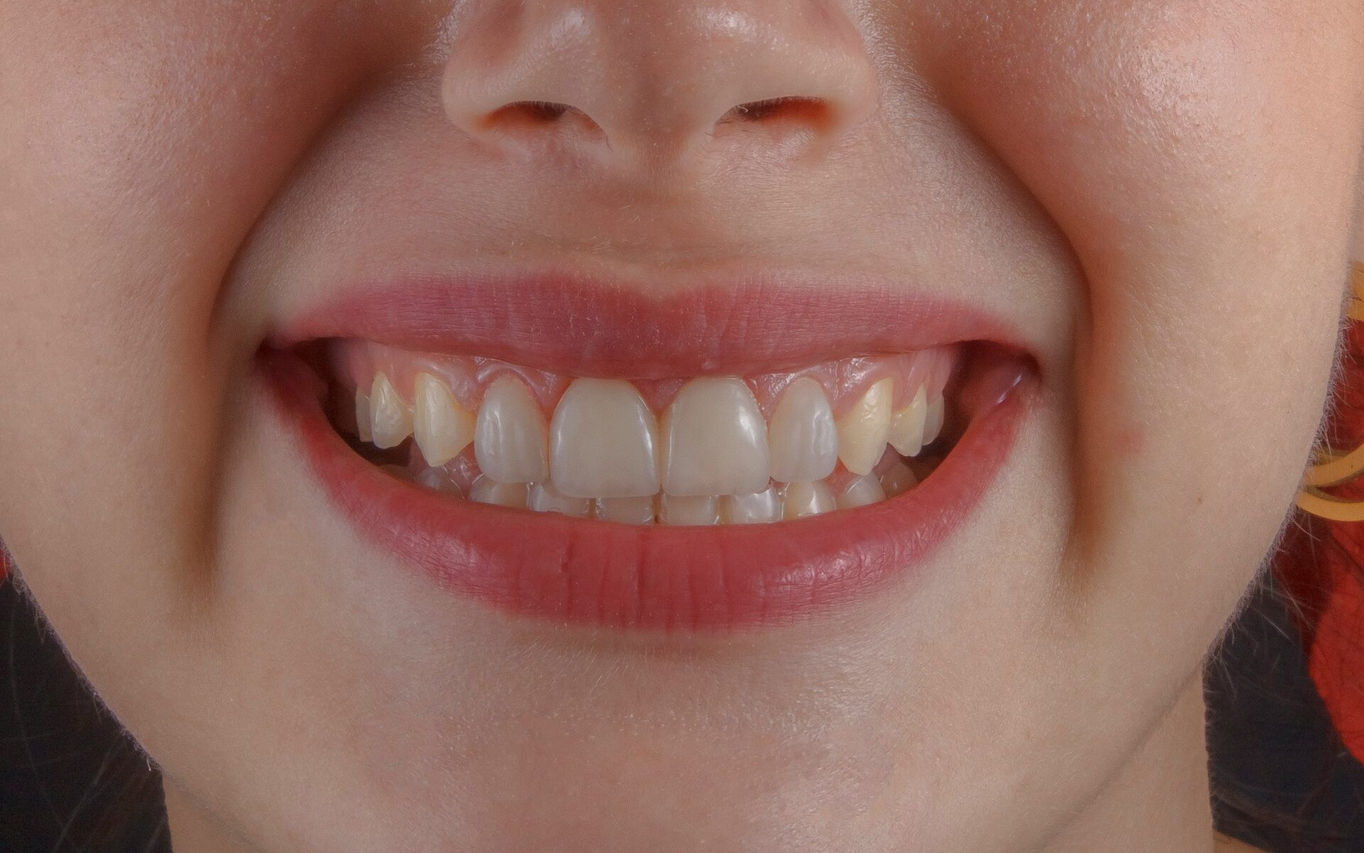 Why Is It Important To Ignore TikTok When It Comes to Filing Teeth?